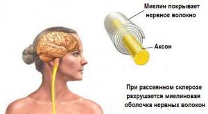 Рассеянный склероз или склероз сосудов головного мозга